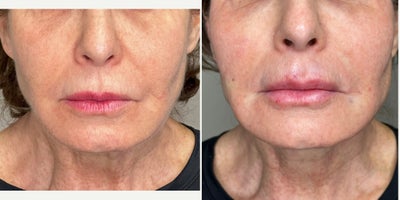 65-74 year old woman treated with Cheek Fillers, Dermal Fillers, Lip Fillers, Miracu, Nonsurgical Facelift, Radiesse, RHA Collec - Facial Rejuvenation in the hands of Dr. Jeffrey Rosenthal, requires a combination of procedures to stimulate collagen with the Endolift Laser, Lift and support sagging face, jaw and neck skin with PDO Threads (Miracu and Mint) and replace lost volume with Radiesse and RHA fillers. Harmony and Balance of the face and neck is the ideal rejuvenation.
