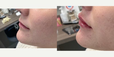 18-24 year old woman treated with Restylane Kysse - The doctor added volume and enhanced the shape of this 24-year-old patients lips with Restylane Kysse.