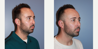 25-34 year old man treated with Rhinoplasty - Rhinoplasty, Chin Augmentation, Otoplasty
