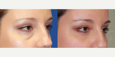 38 year old woman treated with Transconjunctival lower Eyelid Surgery, Fat transfer and CO2 laser - My 38 year old patient was complaining of appearing tired and her eye make up was no longer able to cover up the bags and darkness under her eyes. I suggested she undergo a transconjunctival approach to the lower eyelids, to remove the excess fat pockets which was worse on the right, then I also suggested a facial fat transfer to the upper cheeks to improve the darkness and hollows and I suggest CO2 laser skin resurfacing around the eyes to improve the fine lines, wrinkles, tighten skin and raise the brow and upper eyelid skin slightly. Here she is 4 months post op. Her under eye bags are gone, the skin is soft and smooth in appearance and the shadows are&nbsp;removed from the fat transfer. All the procedures were performed under local anesthesia and took about 2 hours to complete.