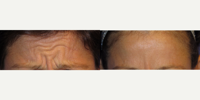 38 year old woman treated with Botox - This female has very animated facial expressions causing wrinkles to appear. She had Botox to reduce the vertical frown lines, horizontal forehead lines, and crows feet. These photos are taken with the patient asked to look angry Note the significant changes is this active position.