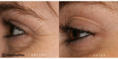 Woman treated with PlasmaPen - What can we treat with Plasma Pen? Excess Eye Bags & Eye Lids  Crows Feet  Lip & Forehead Lines Crepey Neck & Dcollet  Pigmentation