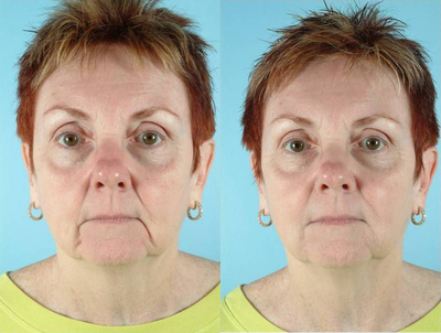 62 Year Old Female Treated for Unwanted Facial Lines - 
	62 Year Old Female

	Diagnosis: Unwanted Facial Lines

	Procedure: Juvederm Dermal Filler to Nasolabial Folds and Marionette Lines
