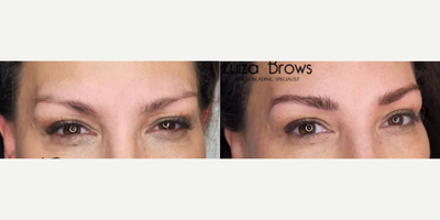 Woman treated with Microblading - Woman treated with Microblading