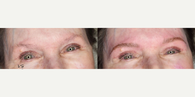 Woman treated with Microblading - Woman treated with Microblading