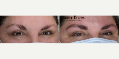 Woman treated with Microblading - Woman treated with Microblading