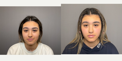 17 or under year old woman treated with Dermal Fillers, Lip Fillers, Restylane Lyft - Under eye and lip filler.