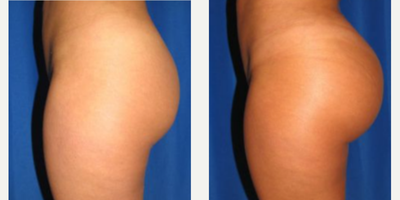 Woman treated with Butt Implants - Woman treated with Butt Implants