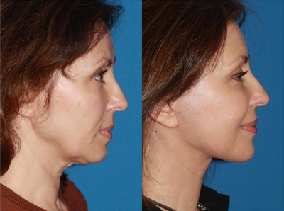 Facelift - Patient underwent facelift