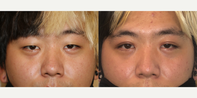 25-34 year old man treated with Double Eyelid Surgery - This is a pleasant 24-year old male of Korean decent. The patient desired a double eyelid fold.