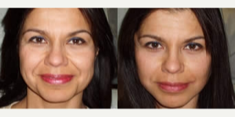 Thread Lift - Woman treated with Thread Lift
