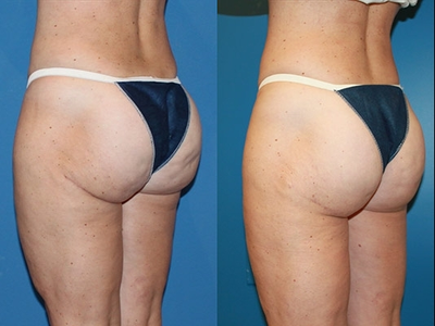 Butt Lift - Butt Lift