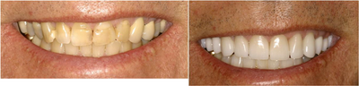 Porcelain Veneers - Teeth get exposed to many different things over a lifetime.&nbsp; The wear and tear can be very detrimental.&nbsp; Porcelain veneers can restore a look from &quot;yesteryear&quot; and give your confidence a boost!This gentleman wanted to look younger, so 20 veneers later he looks 20 years younger!