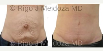 55-64 year old woman treated with Liposuction, Mini Tummy Tuck, Drainless Tummy Tuck - This procedure involves excision of the skin of the abdomen. There's no muscle repair. This patient had lipo of the abdomen and waist with a mini tummy tuck while awake with oral sedation. This was a drainless mini tummy tuck.