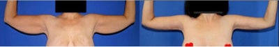 45-54 year old woman treated with Arm Lift - This is a 46YOfemale who weighed 230lbs at her heaviest. Dr. Katzen performed arm lipo. This procedure was performed under general anesthesia with an anesthesiologist. This procedure took 7 hrs. These pictures were taken about 11 months after surgery.