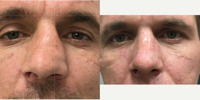 45-54 year old man treated with Rhinoplasty - This gentleman had a deviated crooked nose and we straightened and narrowed it to allow him to breath and look better.