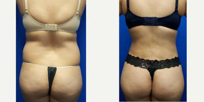 25-34 year old woman treated with Mommy Makeover - The patient is a 26 year old female two months after a tummy tuck and liposuction as part of a mommy makeover. She also had liposuction of her lower back to get more definition of her waist. She had a drainless tummy tuck with exparel for three days of pain relief. She had 1850cc's of fat removed from her lower back and waist. Her height is 5 feet 1 inches and weight was 142 lbs. She has three children.