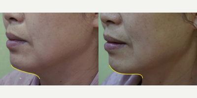 Woman treated with ULTRAcel - Woman treated with ULTRAcel
