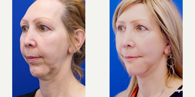 45-54 year old woman treated with Facelift - She is born with facial asymmetry and suffers from lower face deformity from previous chin implant surgery. Staged surgery restores facial proportion which includes revision chin implant, in-office mini lift.