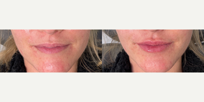 35-44 year old woman treated with Lip Fillers - Lip enhancement using Juvederm Vollure.