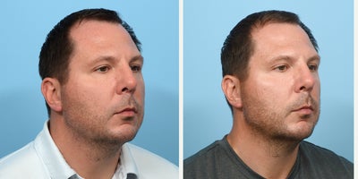 35-44 year old man treated with Chin Filler - Chin and jawline filler with Dr. Wise