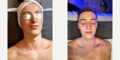 18-24 year old man treated with HydraFacial - 18-24 year old man treated with HydraFacial