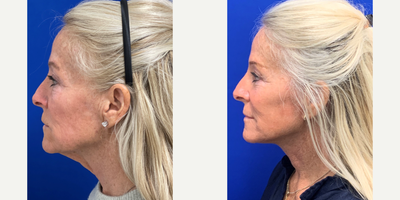55-64 year old woman treated with Facelift, Neck Lift, Eyelid Surgery, Facial Fat Transfer, TCA Peel - 61 year old 3 months  facelift, necklift, upper bleph, lower bleph, fat transfer, tca peel with Dr. Madnani