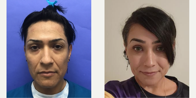 Patient treated with Facial Feminization Surgery, Transgender Facial Feminization Surgery, Rhinoplasty, Septoplasty - 35 to 44 year-old female patient is 9 months post-op from Facial Feminization surgery. Her procedures included: Forehead Lift, Hairline Lowering, Orbital Bony Contouring, Septorhinoplasty (closed) with Cartilage Grafts and Weirs, Chin Reduction and Contour, Voice Feminization Surgery, and Thyroid Cartilage Shave.