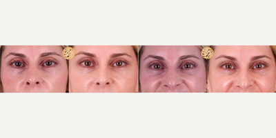 45-54 year old woman treated with Pelleve - Pelleve gives a youthful look by smoothing and removing crows feet and eye wrinkles.