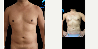 35-44 year old man treated with Liposculpture, Liposuction, SAFELipo - Liposculpture Power assisted.