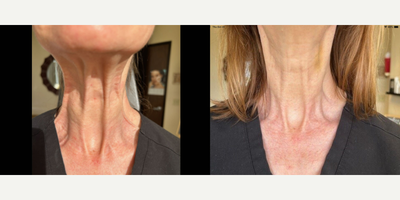 55-64 year old woman treated with Botox - Before and after photos of Botox injected into the platysmal neck bands.