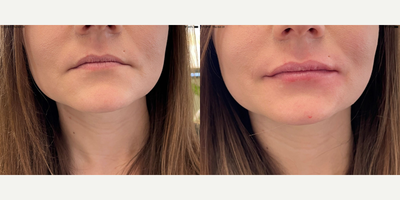 25-34 year old woman treated with Lip Fillers - Before and after photos with Ultra Plus XC