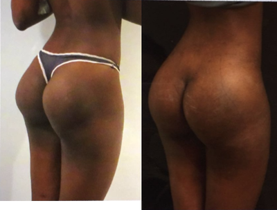 18-24 year old woman treated with Butt Implants - 18-24 year old woman treated with Butt Implants