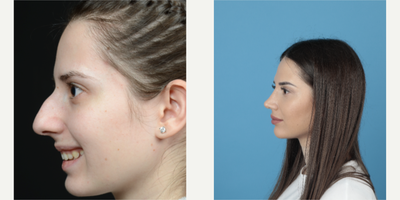 25-34 year old woman treated with Rhinoplasty - long term rhinoplasty results