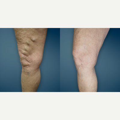 25-34 year old woman treated with EVLT - This patient complained of ropy veins down the inner part of her thigh for about 5 years. After performing endovenous ablation of her great saphenous vein and a microphlebectomy, she was extremely pleased with how her leg looked an felt.