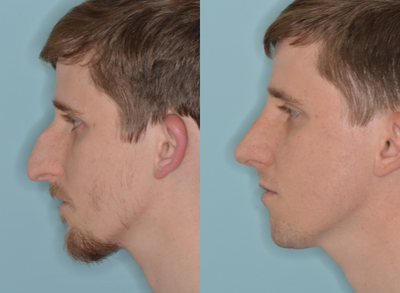 Male rhinoplasty for the tension nose - Male rhinoplasty for the tension nose