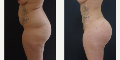 Butt Lift - Woman treated with Brazilian Butt Lift. The patient underwent a Brazilian Butt Lift (butt augmentation with fat transfer). The liposuction snatches her waist and provides the fat for her butt augmentation. The combination of the liposculpting and fat transfer give her a hourglass figure.