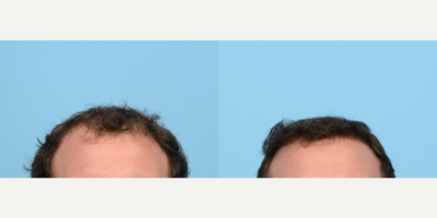 18-24 year old man treated with Hair Transplant, Hair Loss Treatment, PRP for Hair Loss, FUE Hair Transplant, NeoGraft - 24-year-old wanted to add density and strengthen his hairline. Dr. Wise performed an FUE hair transplant with 2,520 grafts and one session of PRP. 6 months post-op the patient's results look fantastic and he will continue to see more growth.