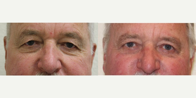 Upper Eyelid Blepharoplasty - This gentleman had a significant upper eyelid skin excess bilaterally that would hang over his eyelashes.
