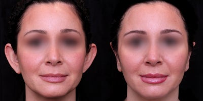 25-34 year old woman treated with Otoplasty (Surgical Ear Pinning) - Otoplasty (ear pinning surgery) 6-week results. Correcting protruding ears for improved proportion and symmetry. Natural-looking transformation.