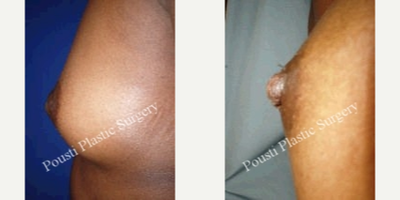 18-24 year old woman treated with Nipple Surgery - This 24-year-old patient, was interested in inverted nipple repair. Patient is 1-week post inverted nipple repair on both sides.
