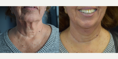 75 and up year old woman treated with EndyMed 3DEEP - Improvement in neck sagging after 3 treatments of RF Microneedling and 3 Deep Endymed .