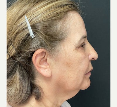 55-64 year old woman treated with Facelift - Facelift & Neck Lift
