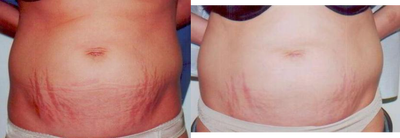 Laser Skin Resurfacing with Smartxide DOT Therapy - 
	This patient had large red stretch marks on her lower abdomen that she aquired after having children. She desired to reduce the size and visibility of these, so she received laser skin resurfacing with the Smartxide DOT Therapy. The Smartxide is a fraxionated CO2 laser that removes the first few superficial layers of skin. Once the skin skins starts to heal it will contract (tighten). This is good for wrinkles, fine lines, age spots and even stretch marks. In some cases two to three sessions may needed.
