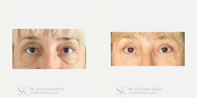45-54 year old woman treated with Eyelid Surgery - Upper and Lower Eyelid Surgery (Blepharoplasty)