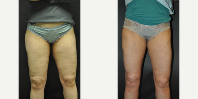 35 year old woman treated with Cellulaze - 35 year old woman treated with Cellulaze as well as Liposuction, shown 2 months post op.