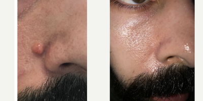 35-44 year old man treated with Mole Removal - Mole removal with shave excision and Mixto co2 laser