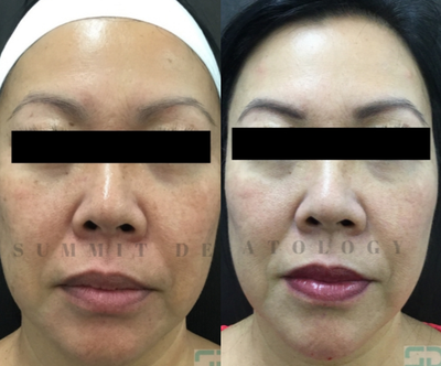45-54 year old woman treated with Pico Genesis - Patient treated with Piocogenesis for dyschromia.
