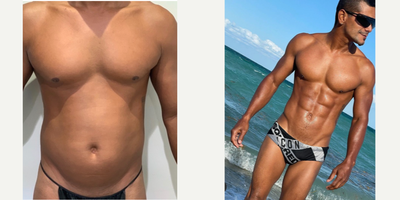 25-34 year old man treated with Abdominal Etching - High Definition Liposuction with Ab EtchingAge: 39SAL abdomen, back, flanksBMI 24.4Height: 57Weight: 156 poundsSNF: 2000ccPostop: 3 monthsNotes: incisions well healed, looks like he did years ago when had abs with natural stair-step appearance of absUnderwent 20 massage therapies