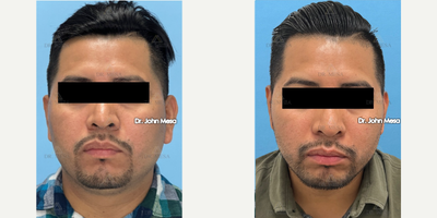 25-34 year old man treated with Extended Chin Liposuction, Mini FaceTite, NeckTite - 25-34 year old man treated with Extended Chin Liposuction, Mini FaceTite, NeckTite